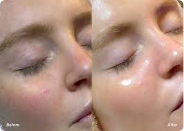 Epi-Glow Dermaplaning Facial